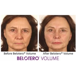 Belotero® Volume with Lidocaine Belotero® Volume with Lidocaine