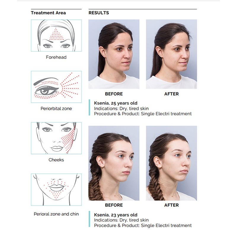 HYALUAL Electri HYALUAL Electri