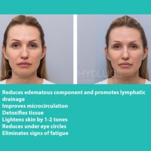 HYALUAL Xela Rederm 1.1 HYALUAL Xela Rederm 1.1