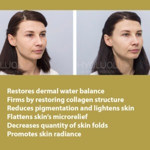 HYALUAL Xela Rederm 1.8 HYALUAL Xela Rederm 1.8