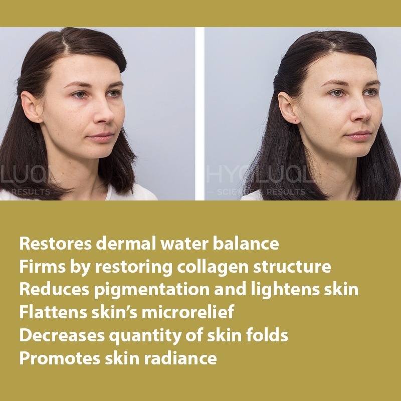 HYALUAL Xela Rederm 1.8 HYALUAL Xela Rederm 1.8