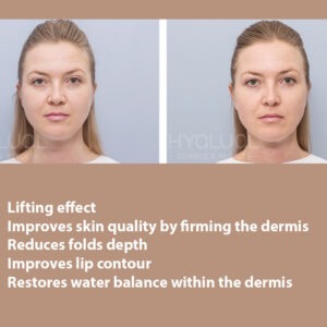 HYALUAL Xela Rederm 2.2 HYALUAL Xela Rederm 2.2