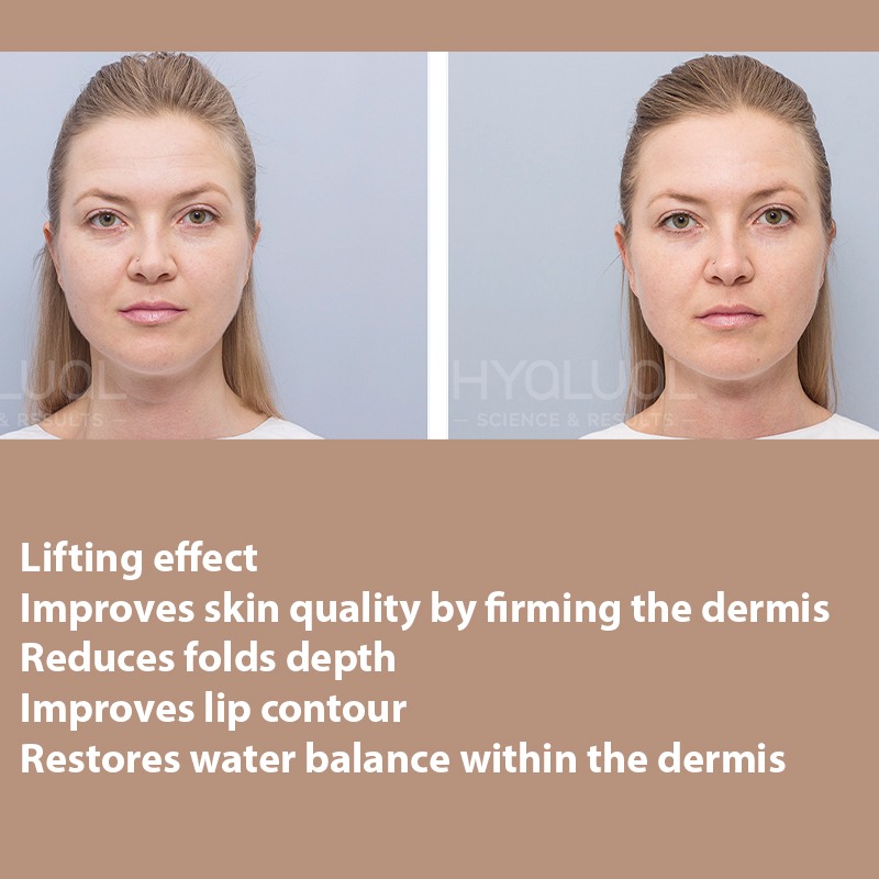 HYALUAL Xela Rederm 2.2 HYALUAL Xela Rederm 2.2