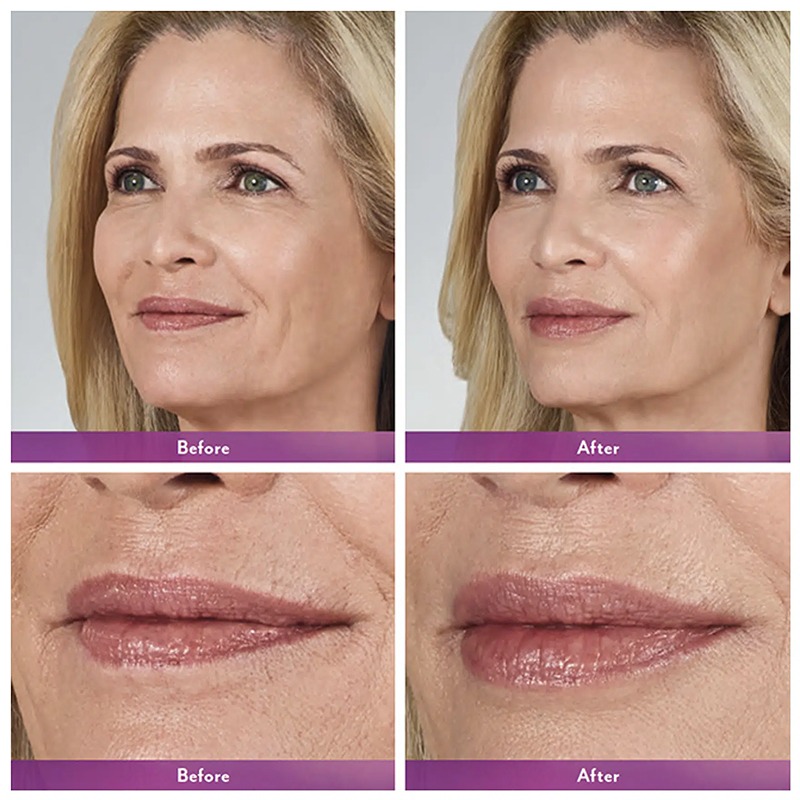 Juvederm ® Ultra 3 with Lidocaine Juvederm ® Ultra 3 with Lidocaine