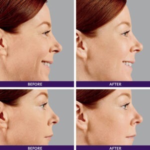 Juvederm ® Ultra 4 with Lidocaine