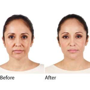 Radiesse Lifting & Volume Filler