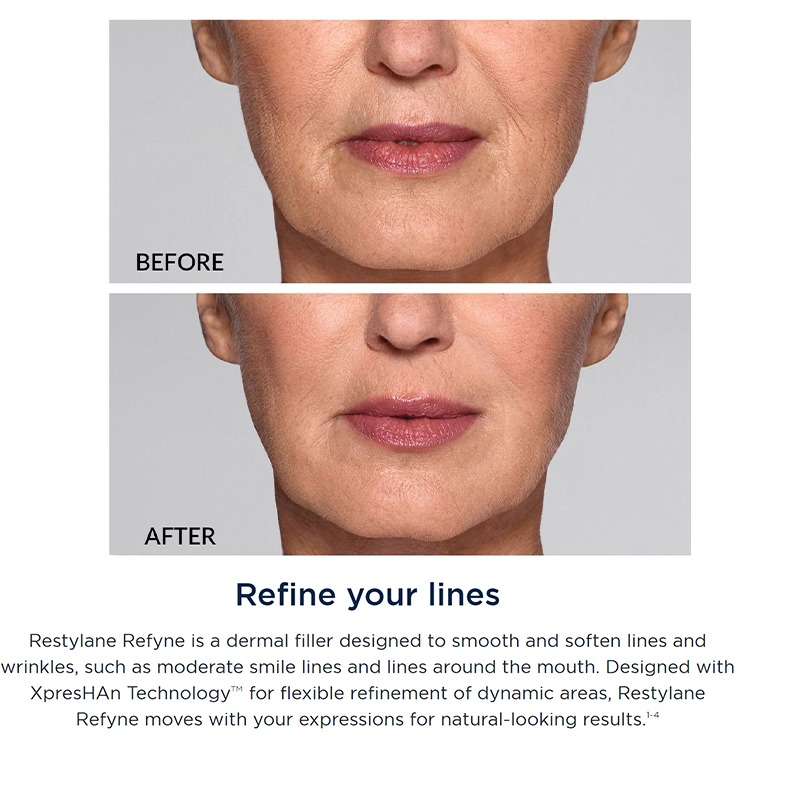 Restylane® Refyne Lidocaine Restylane® Refyne Lidocaine