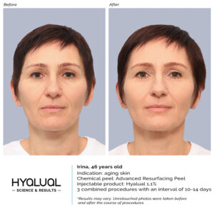 HYALUAL Advanced Resurfacing Peel HYALUAL Advanced Resurfacing Peel