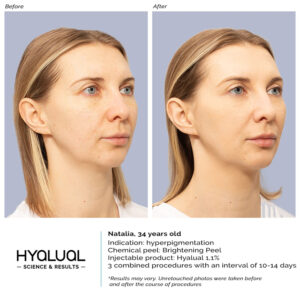 HYALUAL Brightening Peel HYALUAL Brightening Peel
