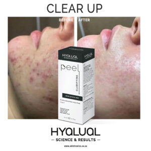 HYALUAL Clarifying Peel HYALUAL Clarifying Peel