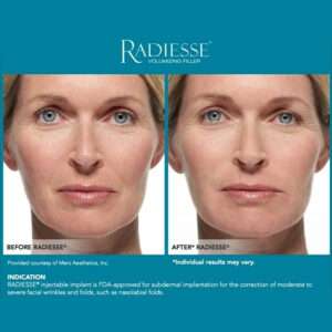 Radiesse with Lidocaine – Lifting & Volume Filler Radiesse with Lidocaine – Lifting & Volume Filler