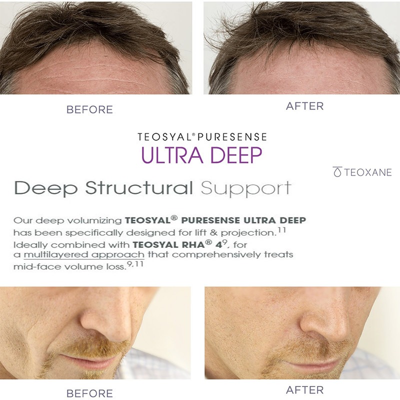 Teoxane Puresense Ultra Deep Teoxane Puresense Ultra Deep