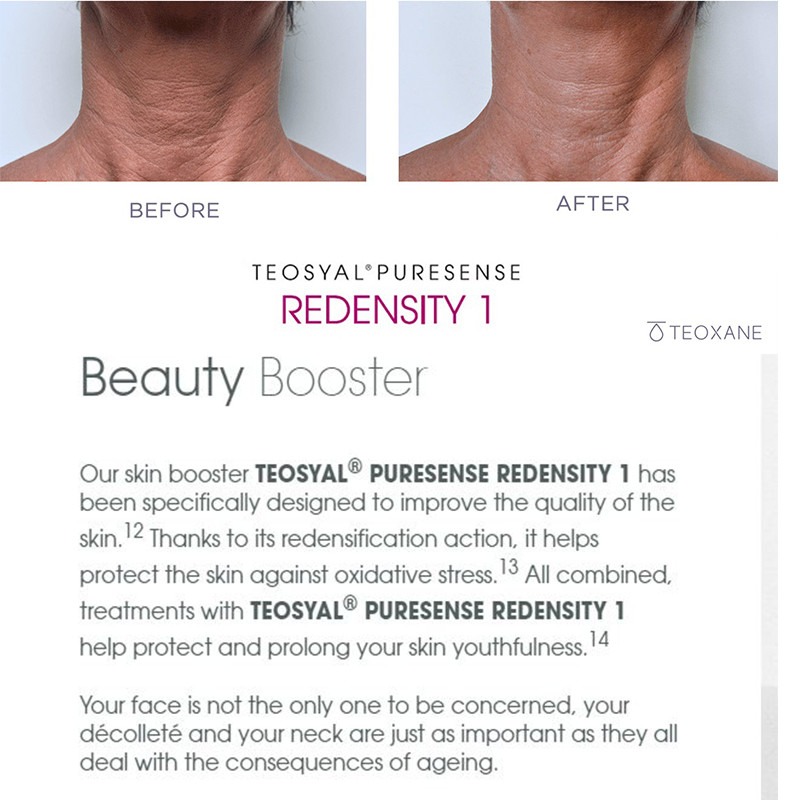 Teoxane Teosyal Redensity 1 1x3ml
