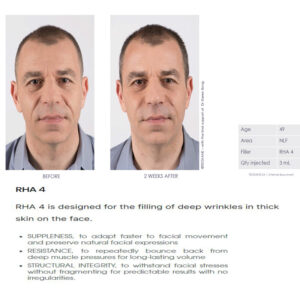 Teoxane Teosyal RHA 4