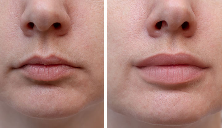 22133-lip-fillers-1177813558 (1)