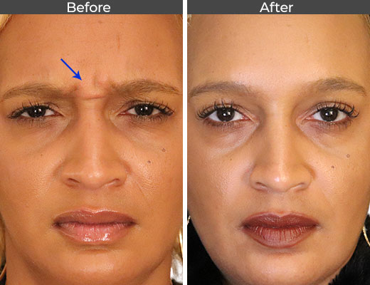 Botox-Before-and-After-JN01 (1)